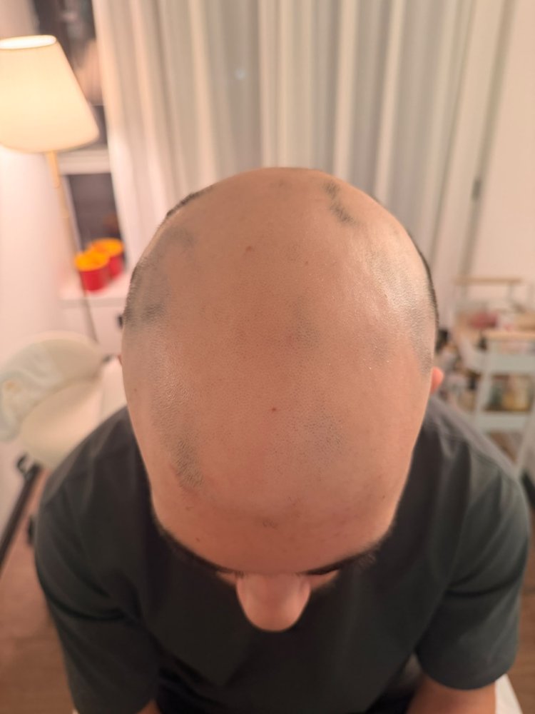 לפני ואחרי טיפול בנשירת שיער אצל גבר — לפני