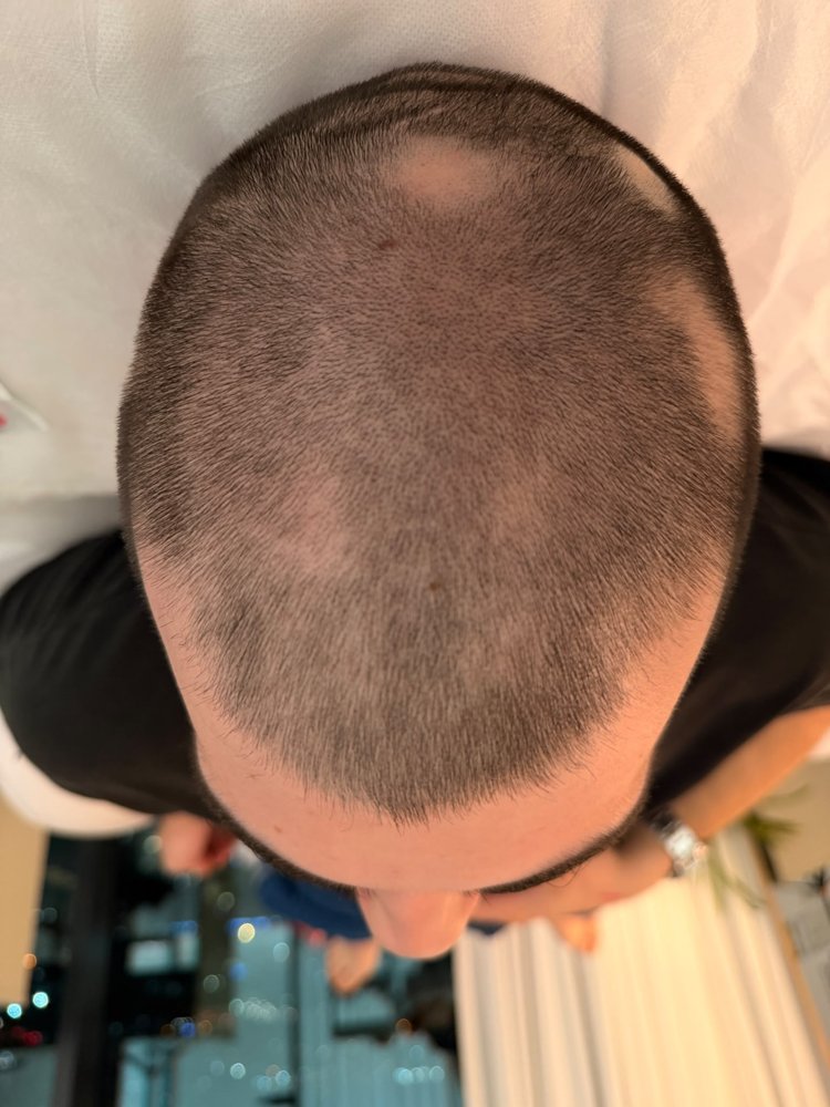 לפני ואחרי טיפול בנשירת שיער אצל גבר — אחרי